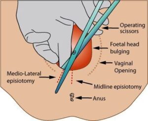 Episiotomía mediolateral