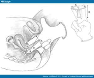 Cómo saber talla pesario uterino