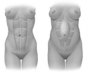 Diastasis hipopresivos