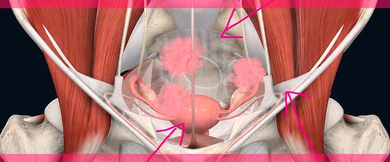 el-tejido-endometrial-se-agrupa-en-focos