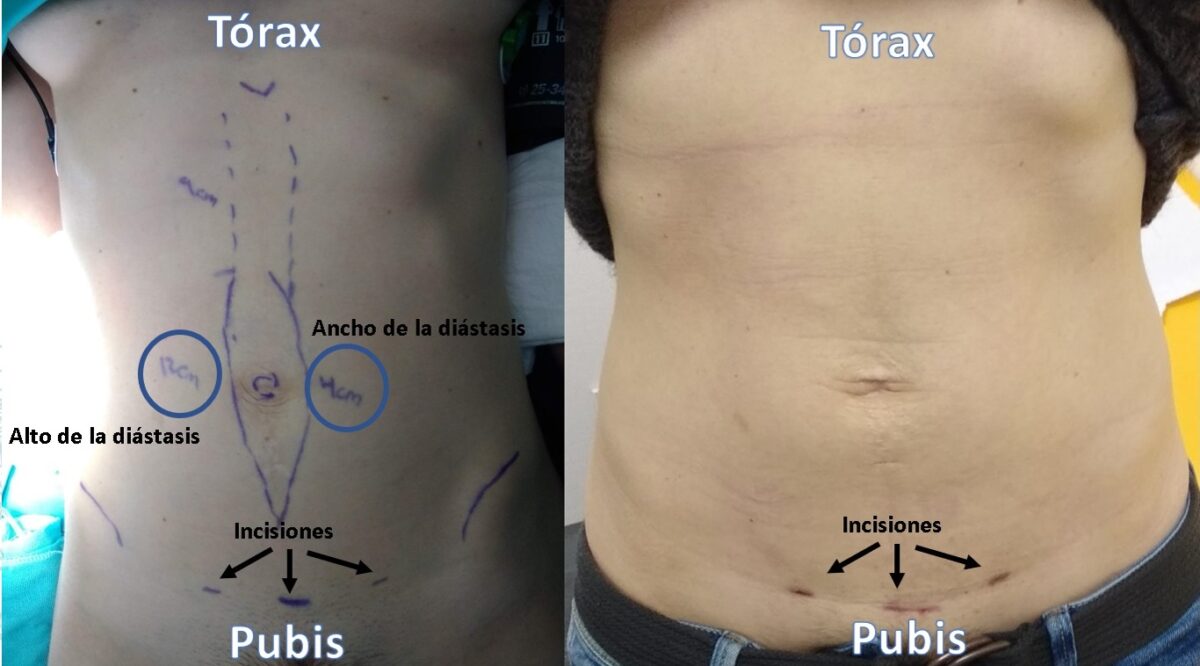 Tratamiento de la diástasis abdominal invasiva