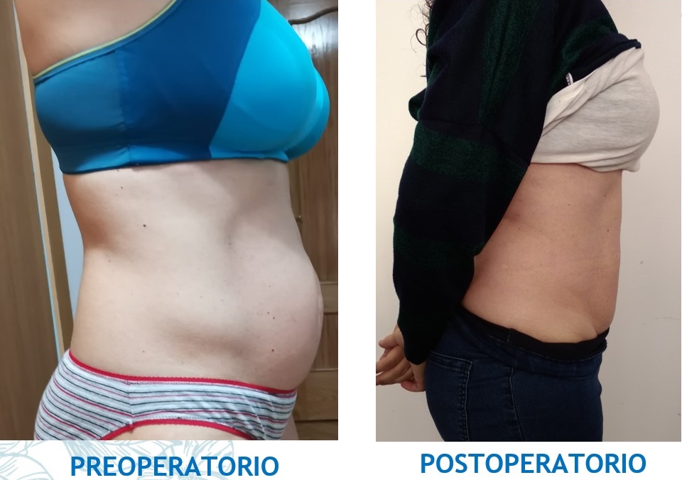 tratar diastasis abdominal